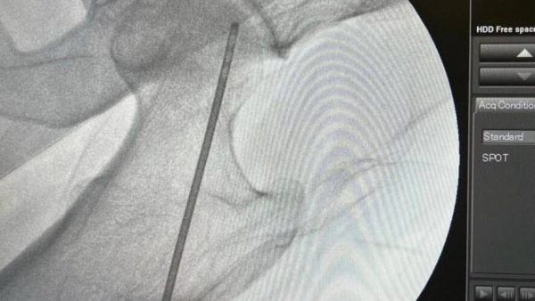 Медики в Татарстане по особой методике спасли суставы женщине с некрозом 27/03/2026 &ndash; Новости